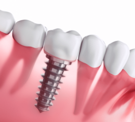 Free Dental Implant by SUS 2023