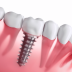 Free Dental Implant by SUS 2023